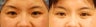 Asian Eyelid Surgery