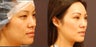 Asian Eyelid Surgery