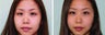 Double eyelid surgery suture