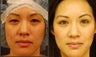 Asian Eyelid Surgery - Double Eyelid Surgery