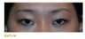 Asian Double Eyelid Incisional Technique