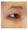 Asian Eyelid Double Eyelid Crease Formation Incisional Technique