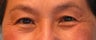 Asian Eyelid Surgery