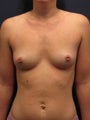 Breast Augmentation