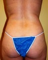 Body Jet (water assisted) liposuction