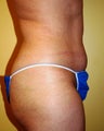 Body Jet (water assisted) liposuction