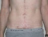Dermolipectomy 