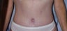 Circumferential body lift and Liposuction