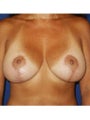 Bilateral mastopexy augmentation with placement of 492cc smooth silicone gel implants