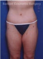 Los Angeles Body Lift