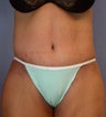 Body Lift