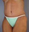 Body Lift