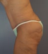 Body Lift