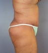 Body Lift