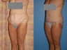 Body Lift