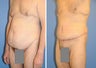 Body Lift