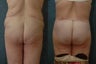 Body Lift (Circumferential Belt Lipectomy)
