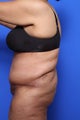 Body Lift with Panniculectomy