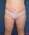 Body Lift 