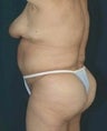 Body Lift 