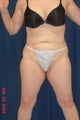 Bodylift