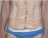 Dermolipectomy 