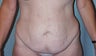 Circumferential body lift and Liposuction
