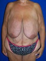 Surgery After Massive Weight Loss
