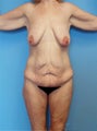 Body Lift