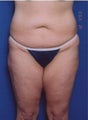 Los Angeles Body Lift