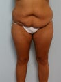 Body Lift