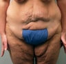 Body Lift