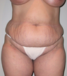 Body Lift