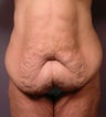 Body Lift