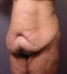 Body Lift