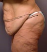 Body Lift