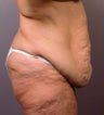 Body Lift