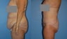 Body Lift