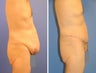 Body Lift