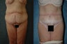 Body Lift (Circumferential Belt Lipectomy)