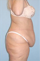 Body Lift