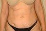 Body Lift