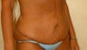 Body Lift