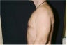 Male Breast Reduction