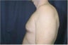 Male Breast Reduction