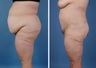 Bilateral Lower Body Lift and Liposuction