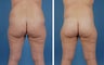 Lower Body Lift and Liposuction of Lateral Thighs