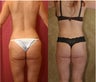 body lift