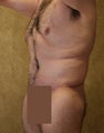 body lift
