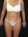 Body  Lift